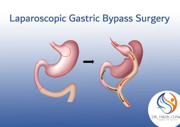 Mini-Gastric Bypass