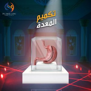 عملية تحويل المسار الإسباني | أهم الأسئلة حول الجراحة